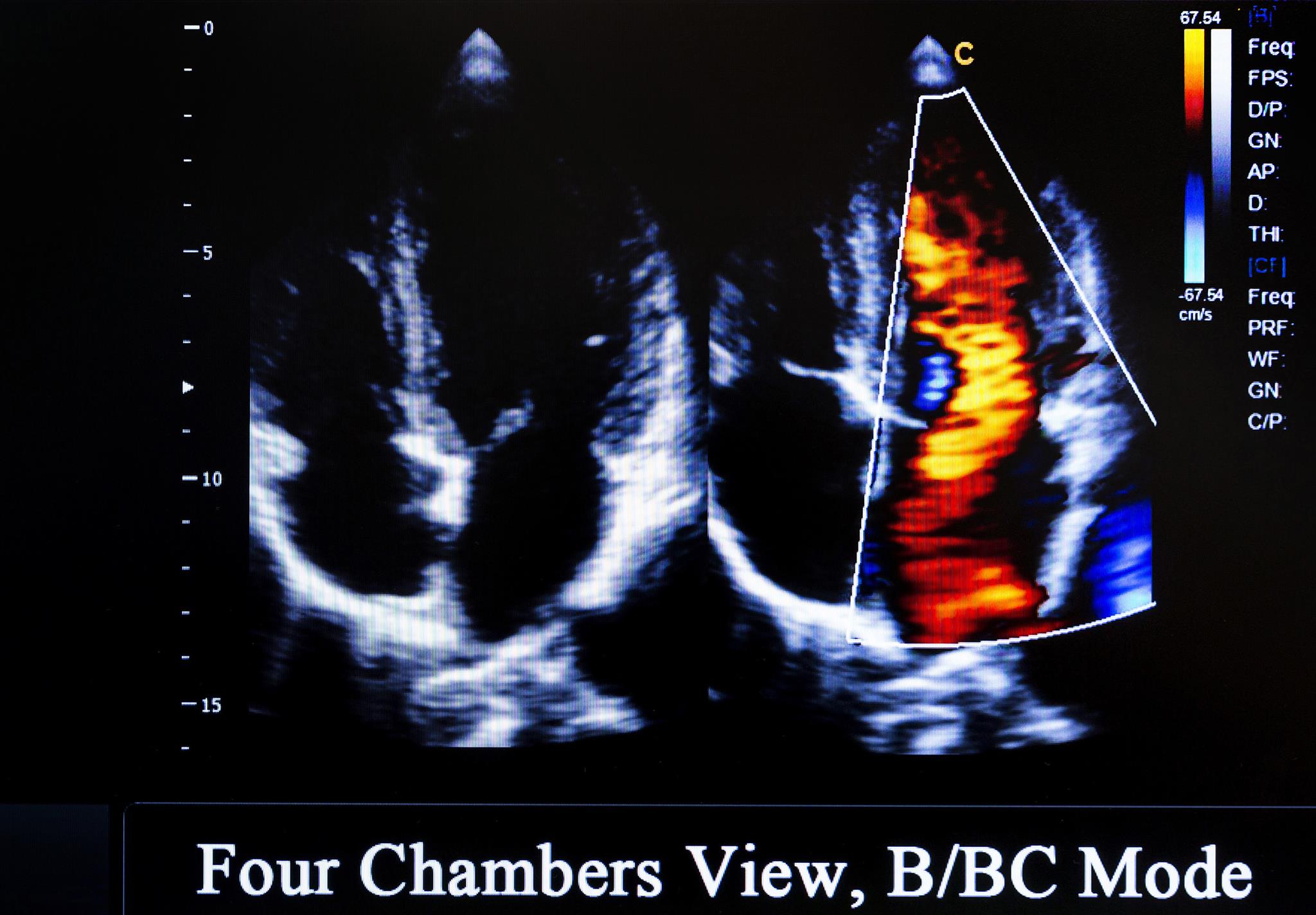 exercise-stress-echocardiogram-cardiologist-perth-wa-access-cardiology